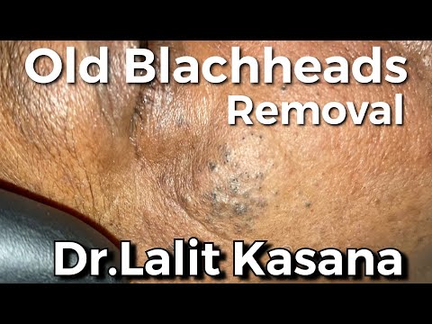 Old Blackheads & Comedones Removal by Dr.Lalit Kasana