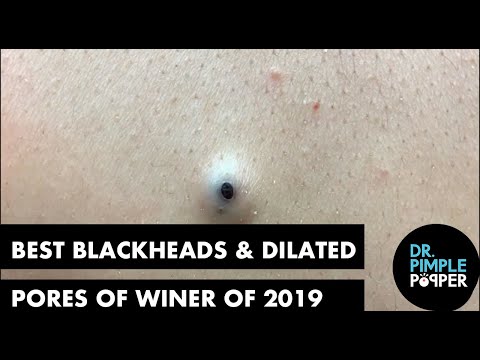 Best Of Blackheads and Dilated Pores of Winer for 2019