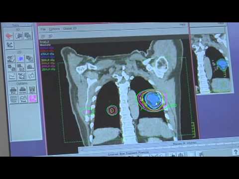 Cancer Treated with Radiation Therapy