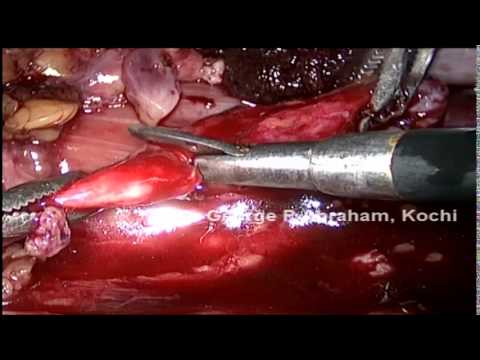 Laparoscopic salvage ureterocalicostomy for failed...