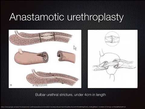 Substitution Urethroplasty: Techniques using grafts...