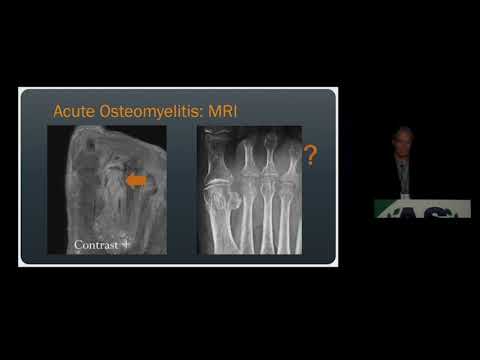 Imaging of Osteomyelitis & Septic Arthritis | 15...