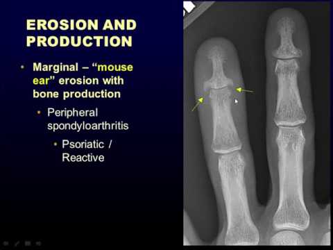 Radiographic Approach to Arthritis