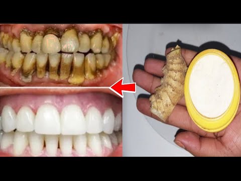 Magical Teeth whitening remedy, Get whiten Teeth at...