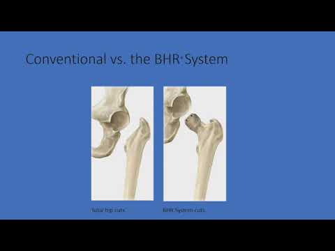 Hip Resurfacing and Management of Arthritis in Young...
