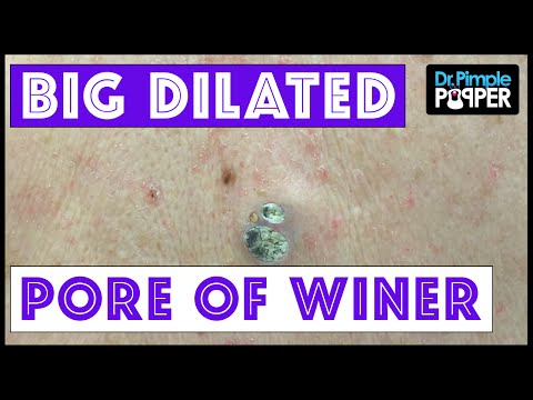 Two HUGE Dilated Pores of Winer!!