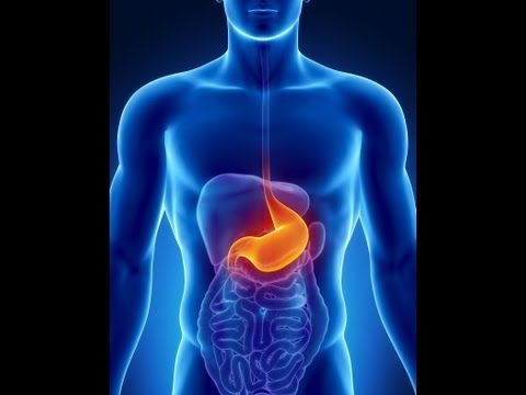 Causes of Colon Cancer