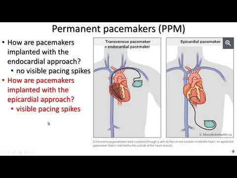 Permanent pacemakers and implantable cardiac...