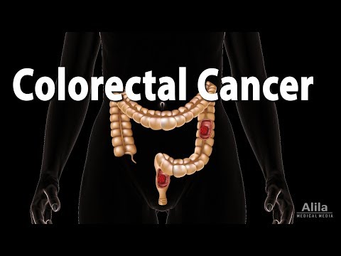 Colon Cancer: Pathology, Symptoms, Screening, Cause...