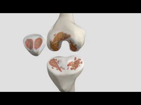 Total Knee Replacement Patient Animation