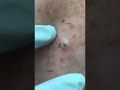 GIANT Blackhead removed from the Back! w/ Dr. Pimple...