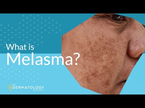 What is Melasma? | Melasma Treatment Explained