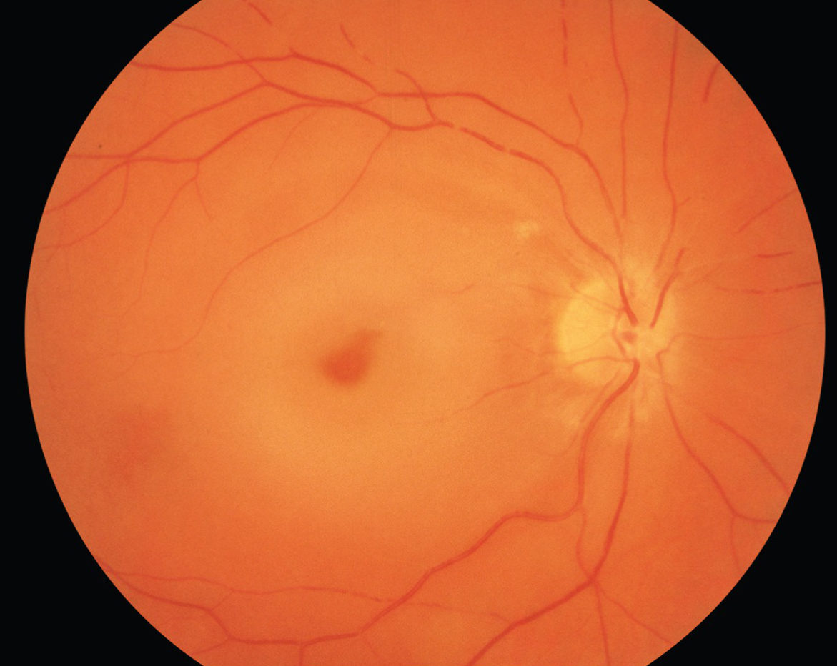 Retinal Artery Occlusion Ohio Eye Closeup