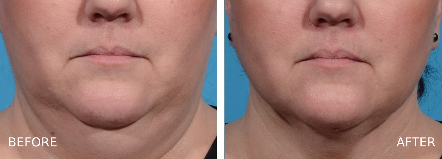 Facetite Before and After Woman's Chin