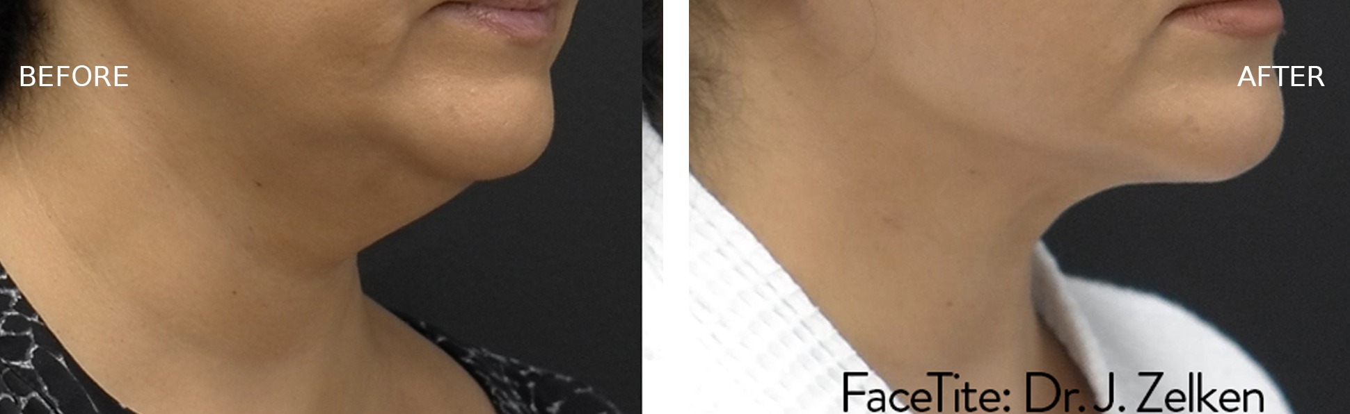 Woman's Face Before and After FaceTite