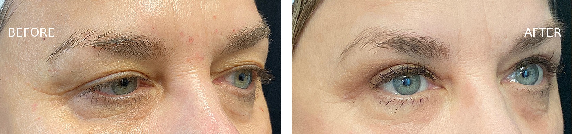 Woman's Eyes Before and After AccuTite
