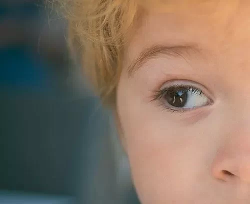 Childs Eye with Amblyopia
