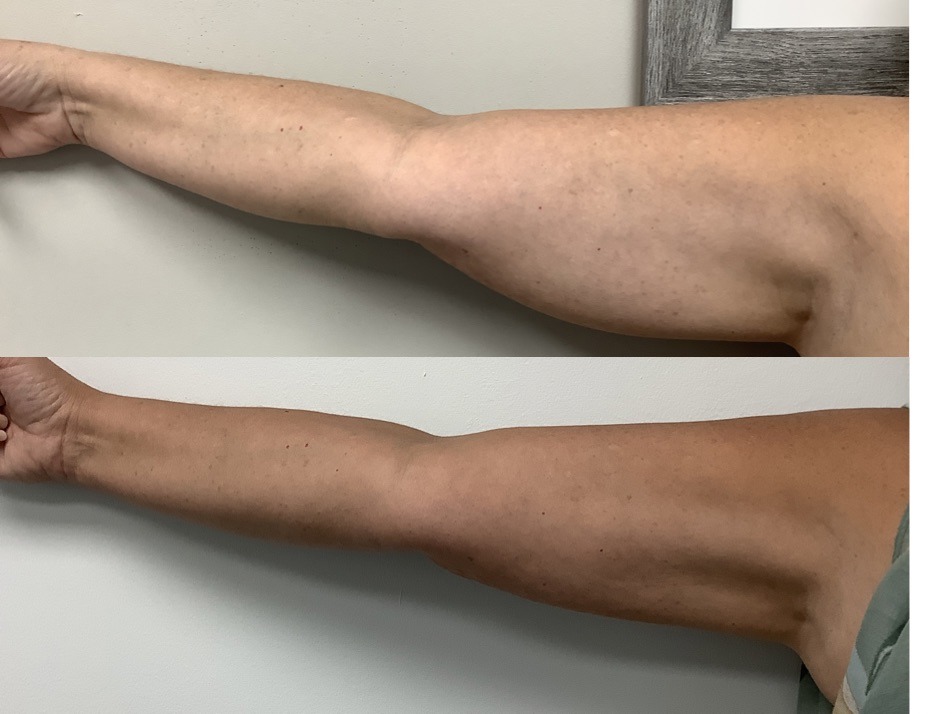 Before and After Bodytite Arms - Gallery