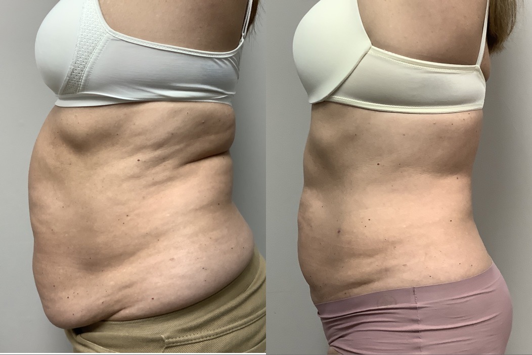 Bodytite abs left side - BodyTite Before and After