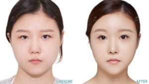 Before After Face Contouring In Korea