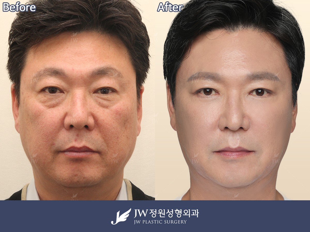 Price for Male Plastic Surgery in Korea Common Plastic