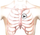 Pulmonary Hypertension course image