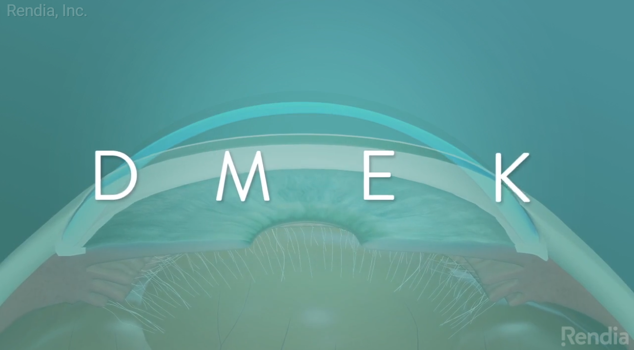 New Eye Care Videos Explain IOLs, DMEK, MIGS to Patients