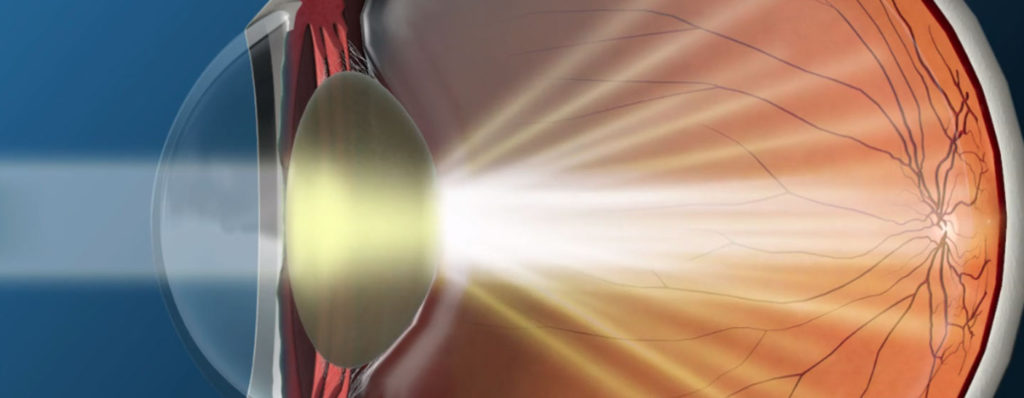 Illustration of an eye with a cataract