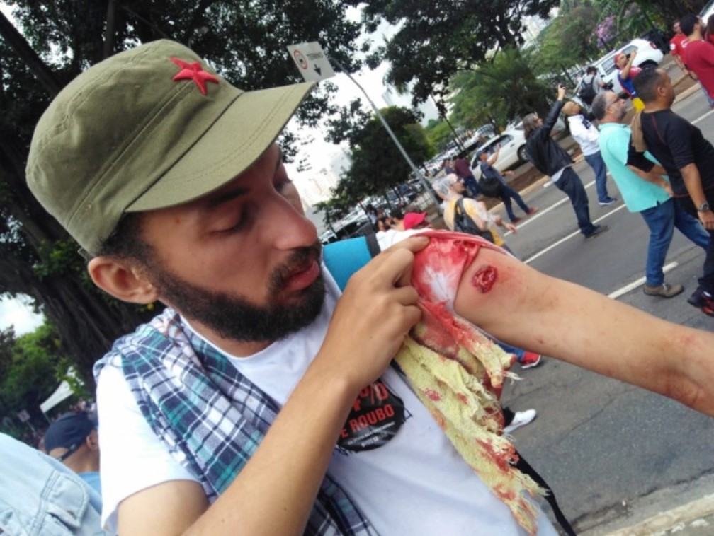 Servidor mostra marca da bala de borracha atirada por PMs durante ato contra votação da Reforma da Previdência de São Paulo na Alesp. — Foto: Reprodução/CUT SP