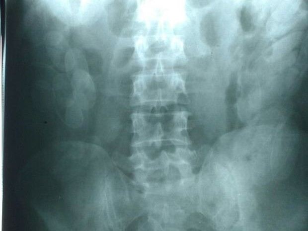 Raio-x apontou as cápsulas no estômago do boliviano  (Foto: Polícia Rodoviária / Divulgação)