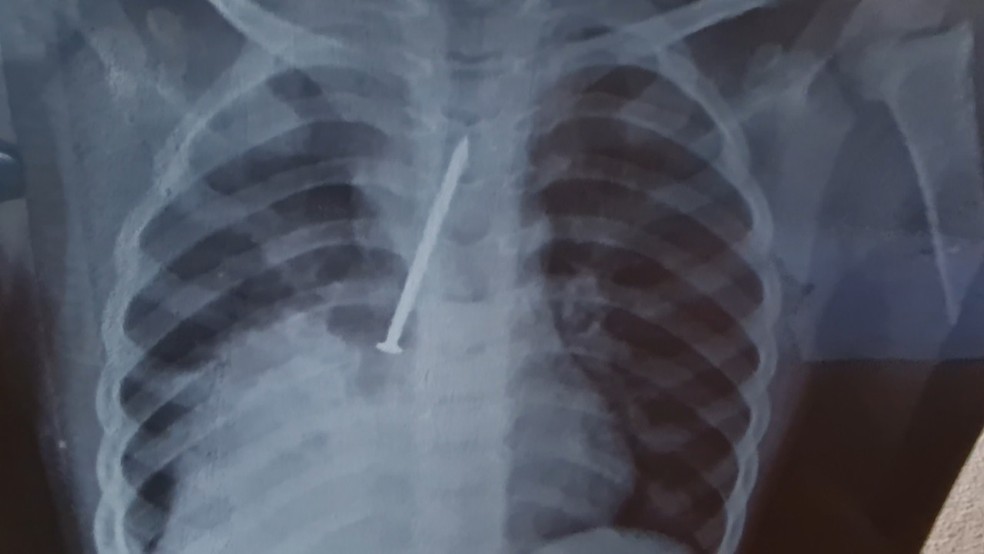 Menino morre após passar 1 ano com prego no pulmão — Foto: Reprodução/TV Santa Cruz