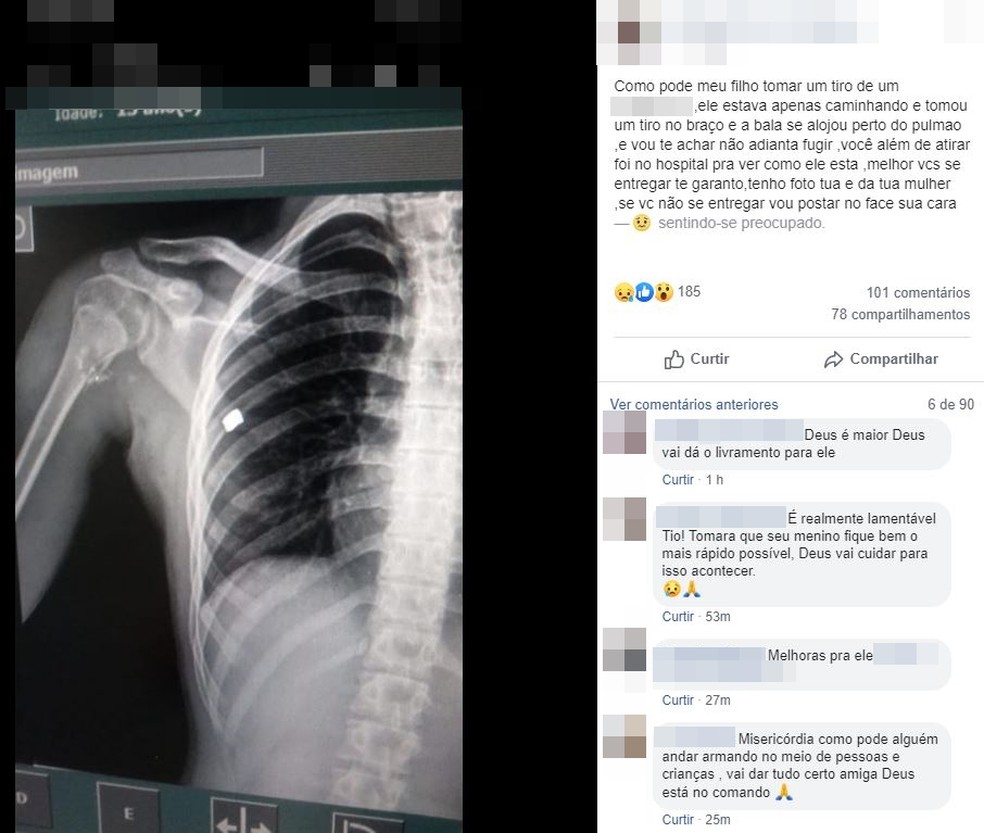 Pai divulgou imagem de raio X de adolescente baleado em Piraju (SP) — Foto: Reprodução/Facebook