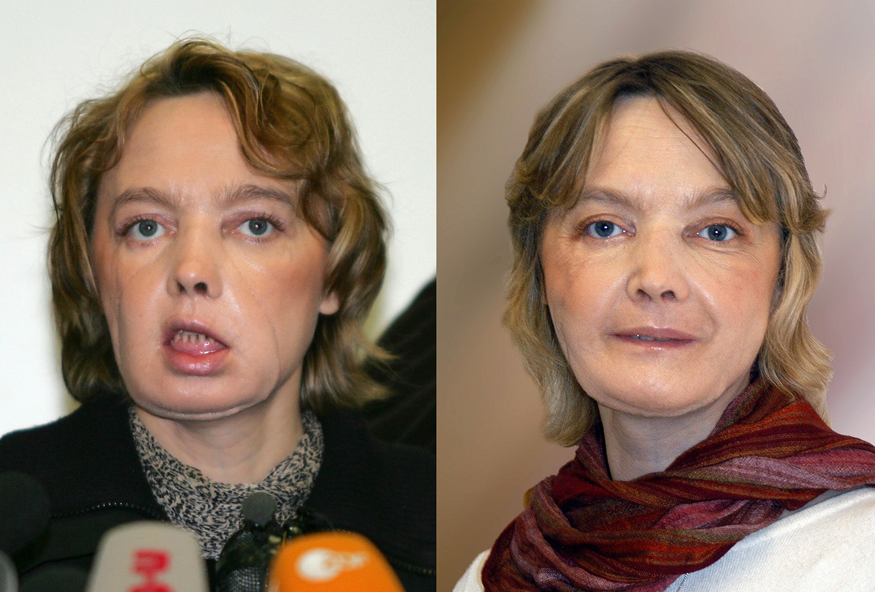  Fotos mostram Isabelle Dinoire em fevereiro de 2006 (esq.) e em novembro de 2006 (dir.), alguns meses depois sua cirurgia de transplante de face (Foto: DENIS CHARLET / AFP &amp; CHU AMIENS / AFP)