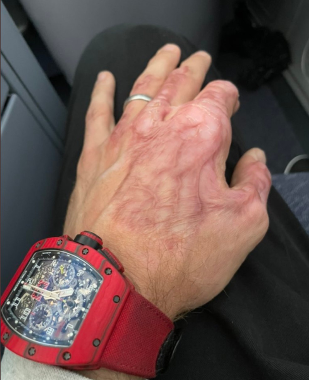 Romain Grosjean mostra cicatrizes quase um ano após acidente  — Foto: Reprodução/Redes sociais