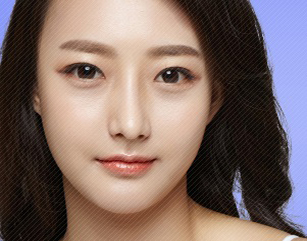 Forehead And Chin Implants In Korea