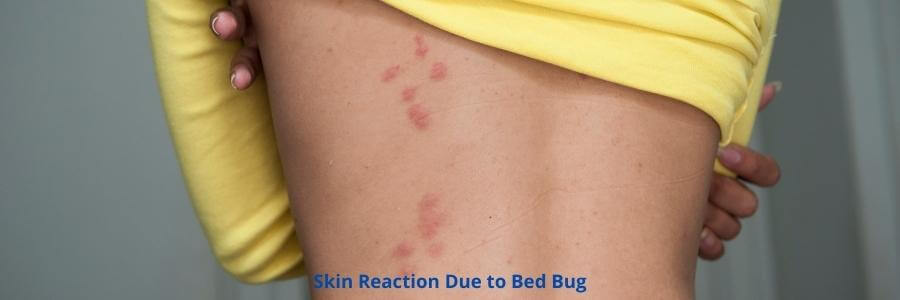 Skin Reaction Due to Bed Bug
