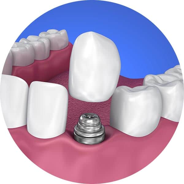 Dental Crown Implant