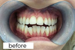 Invisalign Dental Treatment Before
