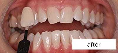 Teeth Whitening Treatment Preston
