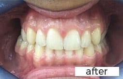 Invisalign Dental Treatment After
