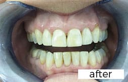 Invisalign Dental Treatment After