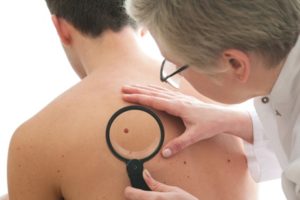 איך לאתר סימנים מוקדמים לסרטן העור