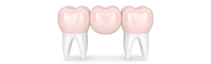 dental-crowns-hornsby
