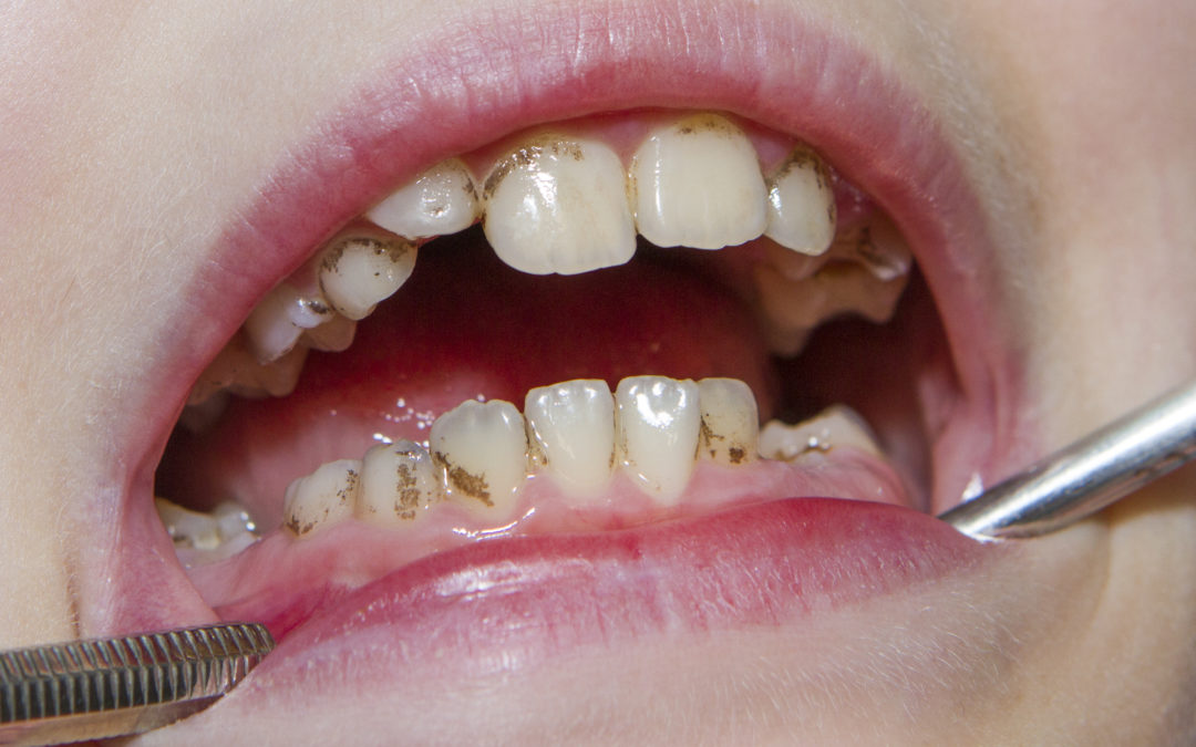 What Are The Different Types Of Teeth Stains?