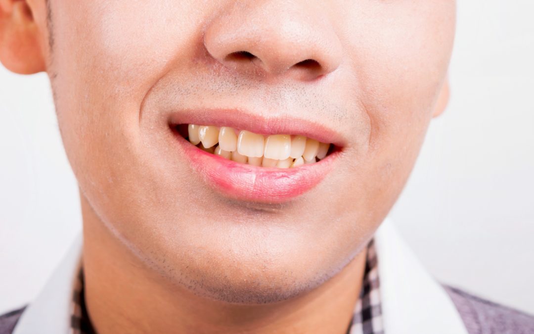What Causes Tooth Discolouration And Stains?