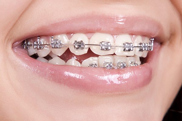 تقويم الأسنان المعدني التقليدي