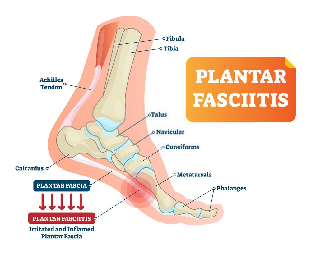Can plantar fasciitis go away on its own?