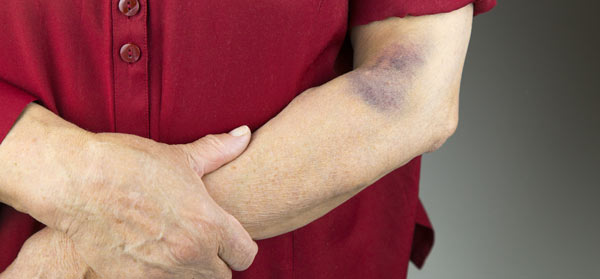 Senior woman with big bruise on upper arm