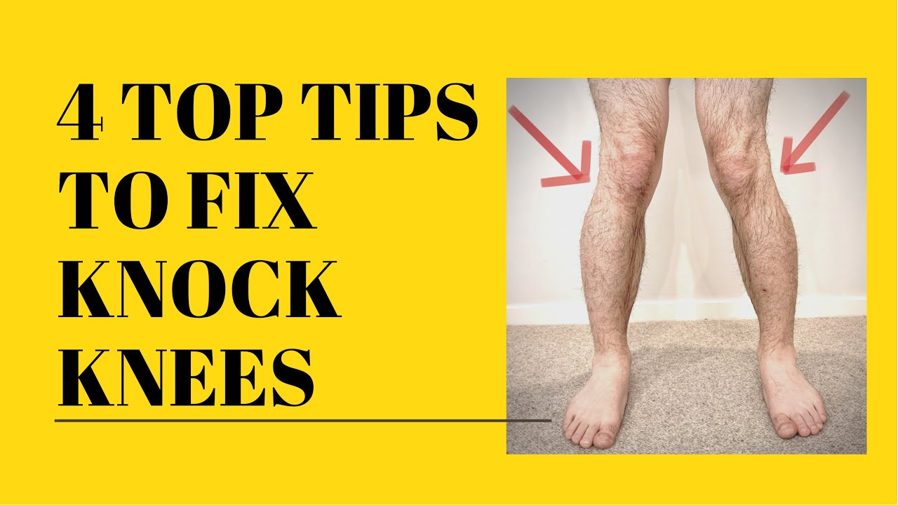 Knock Knees Fix